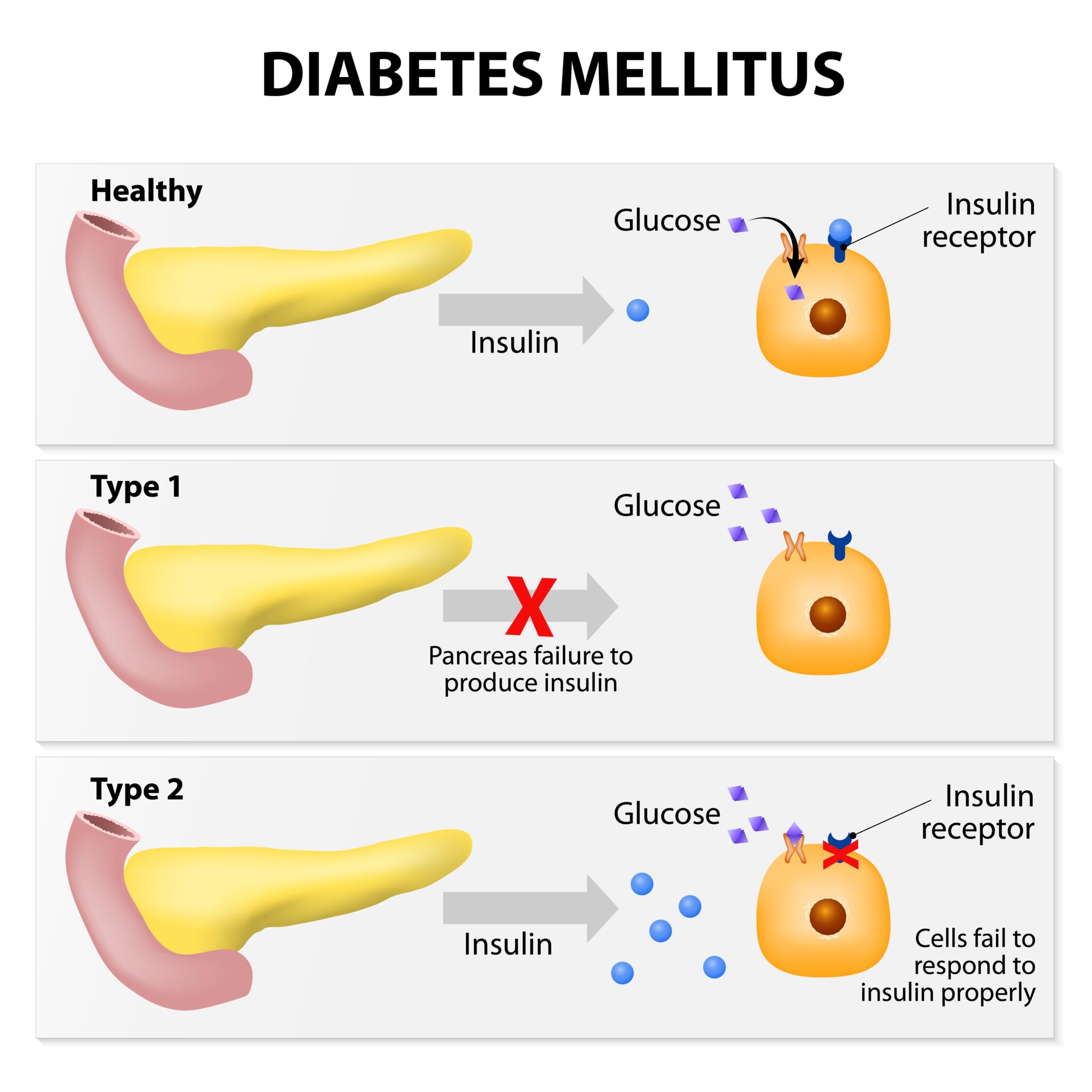 Diabetes Mellitus pathology
